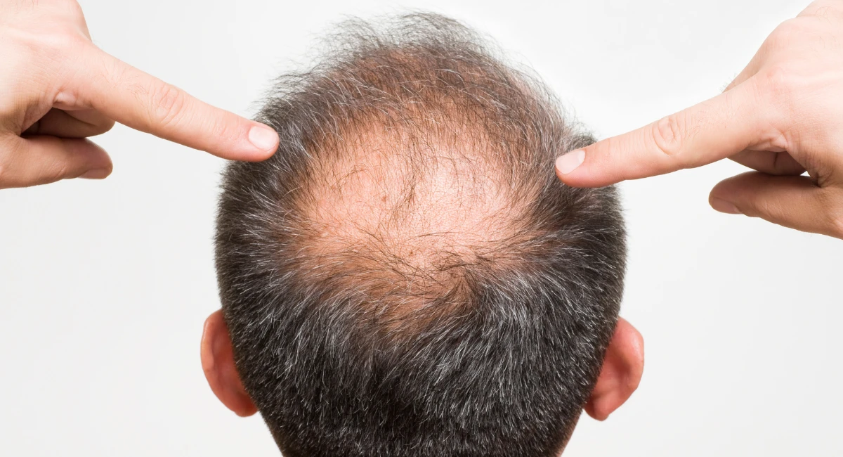 Baldness