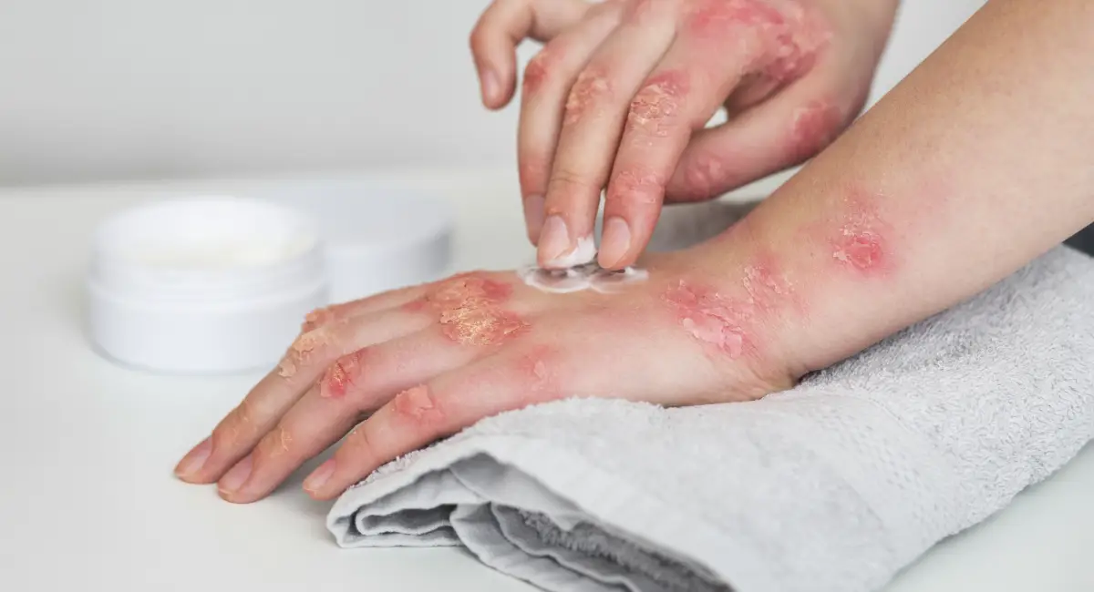 Eczema