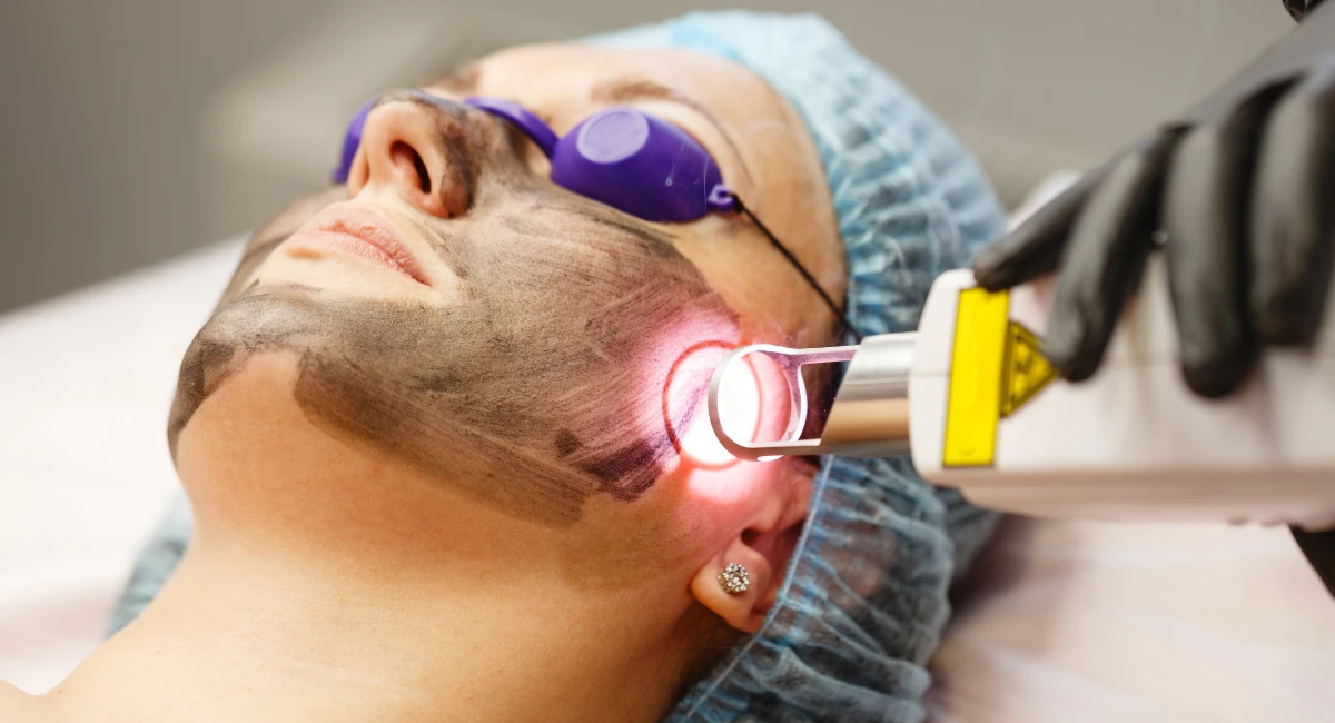 Laser Skin Resurfacing
