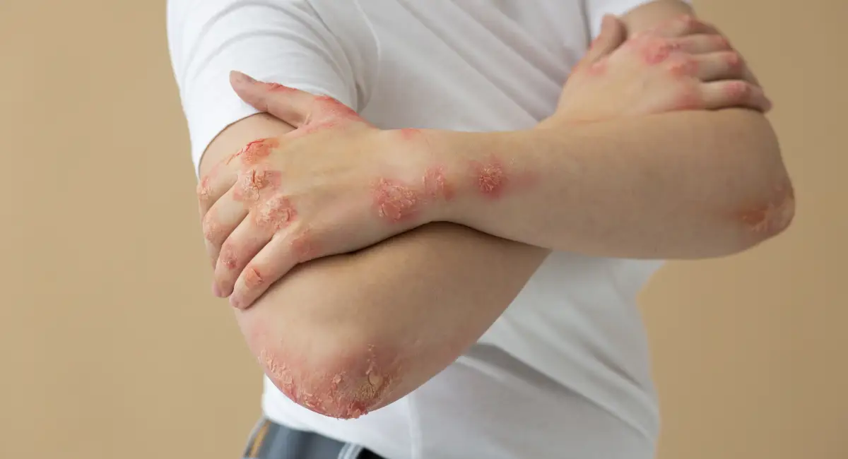 Lichen Planus