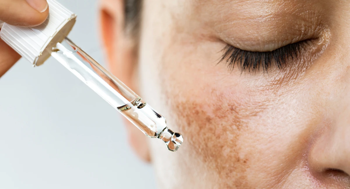 Melasma Treatment