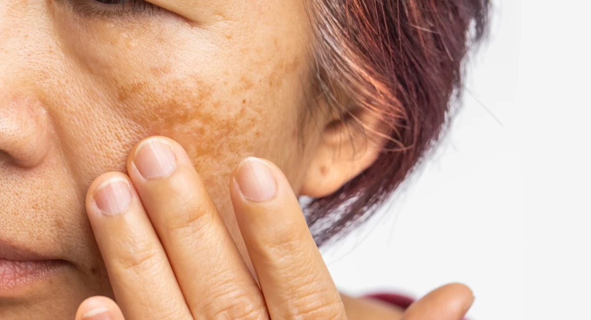 Pigmentation Treatment