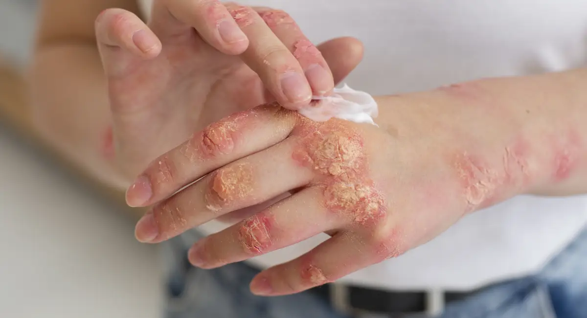 Psoriasis