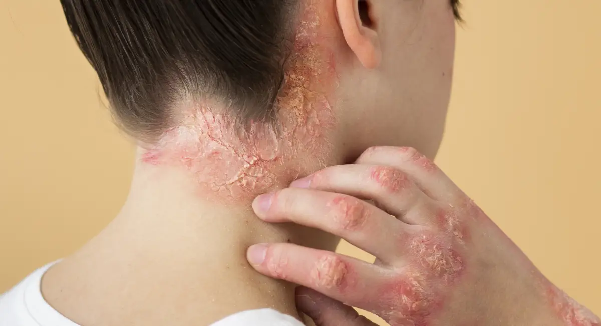 Ringworm