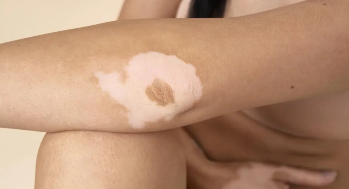 Vitiligo